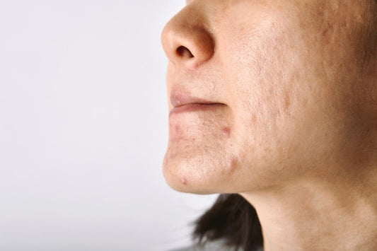 close up of inflamed acne lesions and post inflammatory marks on chin and jawline