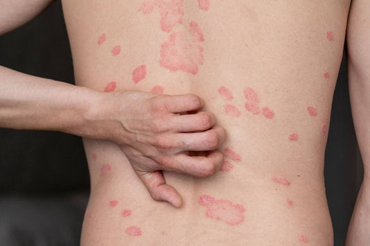 Infographic for PSORIASISTRIGGERSWHATYOUSHOULDKNOW