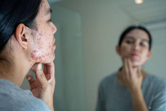 Infographic for UNDERSTANDINGINFLAMMATORYACNE