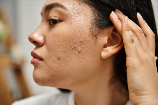 woman with different acne types