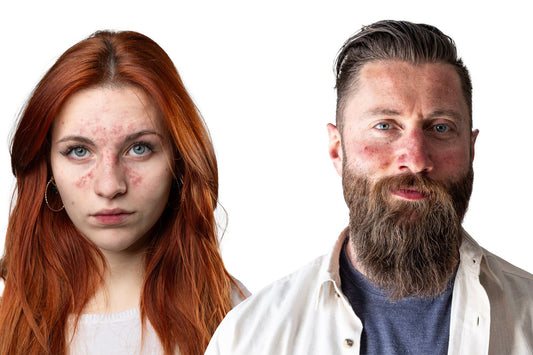 Preview image for build-skincare-routine-for-rosacea-relief
