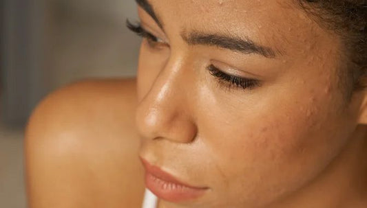 Preview image for effective-ways-to-help-your-acne-scars-heal