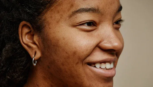 Preview image for hyperpigmentation-how-to-reduce-dark-spots-on-your-skin