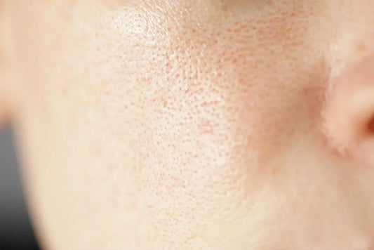 close-up of skin with enlarged pores and uneven texture