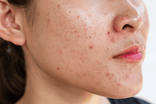 woman with inflammatory acne