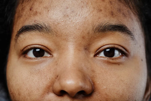 woman with dark spots from acne