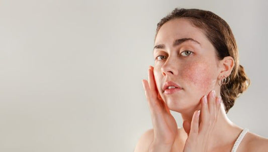 Preview image for rosacea-101-how-to-reduce-rosacea-symptoms