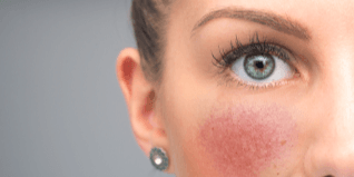 Preview image for rosacea-and-the-demodex-mite
