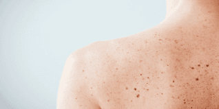 Preview image for skin-cancer-awareness