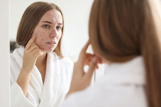 woman examining acne on her face in the mirror