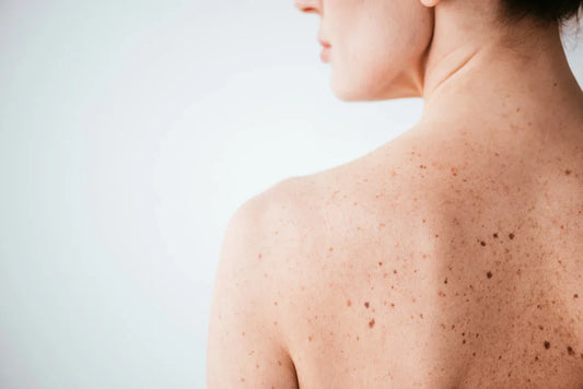 solar lentigines on upper back caused by sun exposure