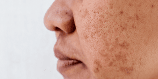 Preview image for what-is-pigmentation