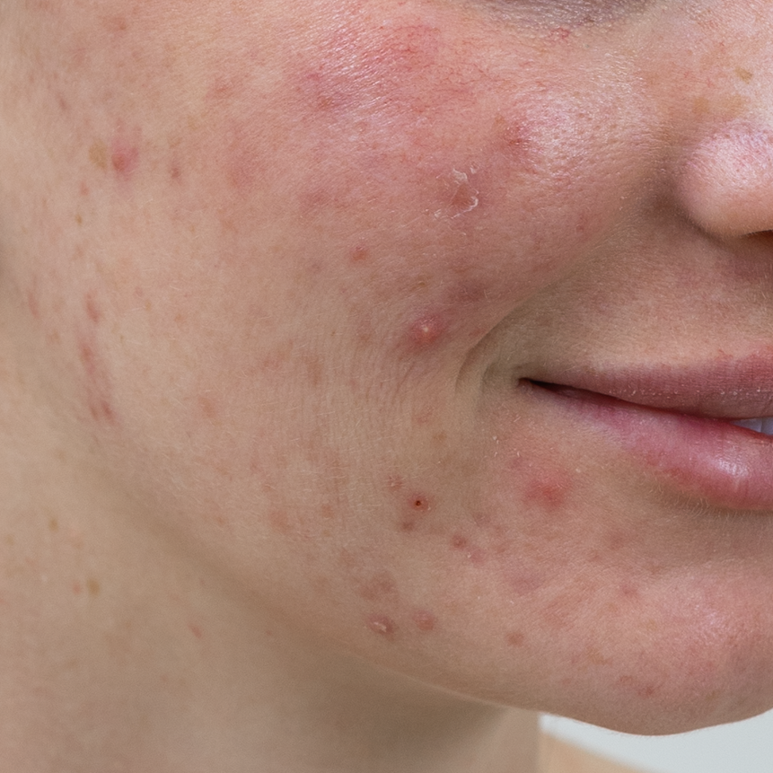 Acne
